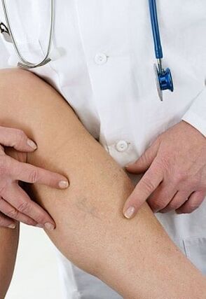 Κιρσοί των κάτω άκρων