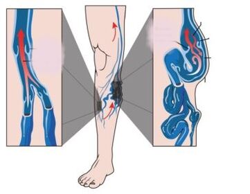 Αιτίες, συμπτώματα